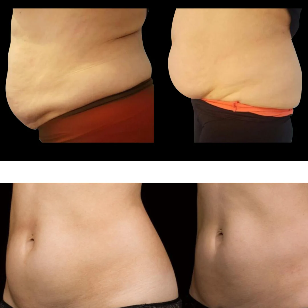 2026 Adonis™ II 30K Fat Blasting Cavitation Machine 6 in 1 - Image 10