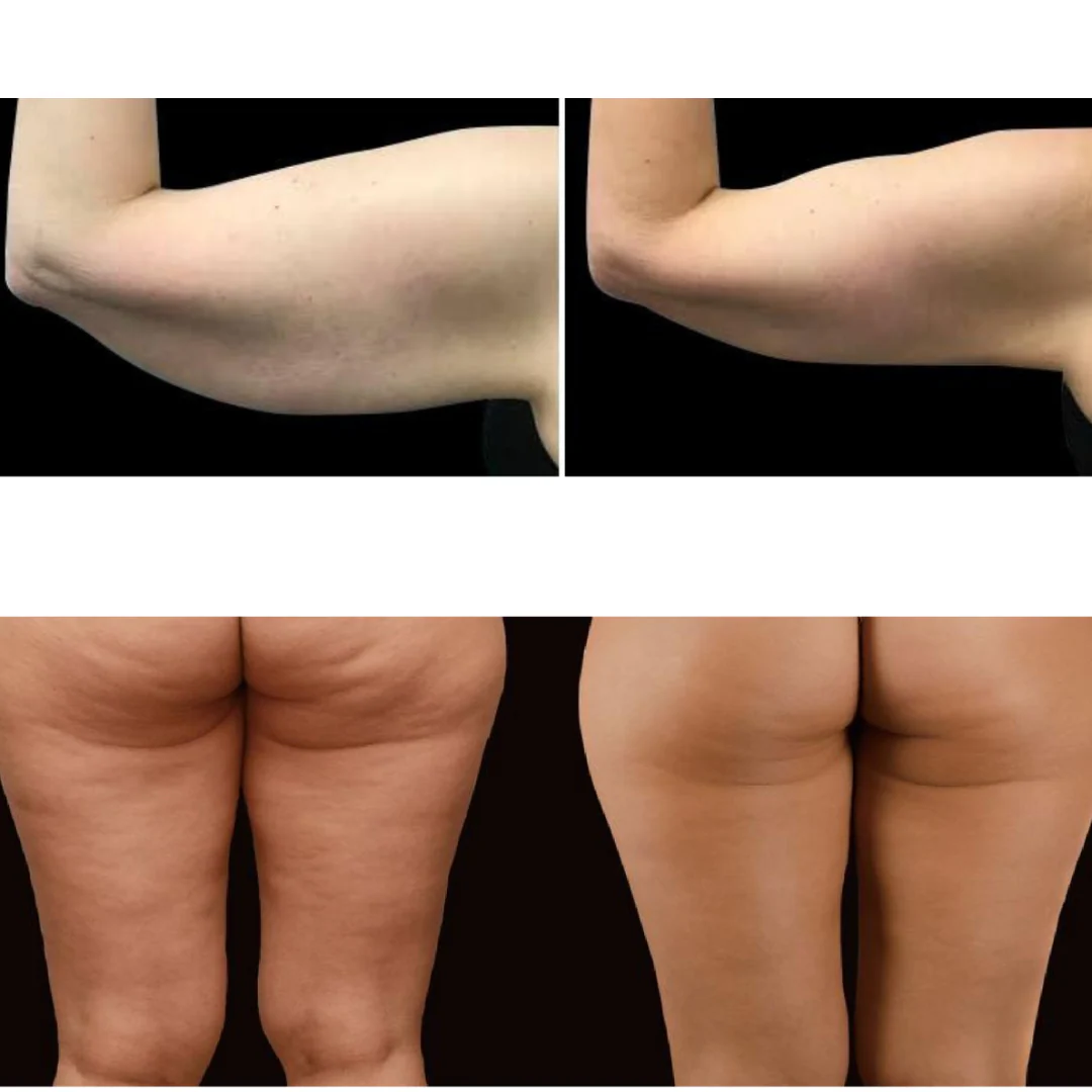 2026 Adonis™ II 30K Fat Blasting Cavitation Machine 6 in 1 - Image 9