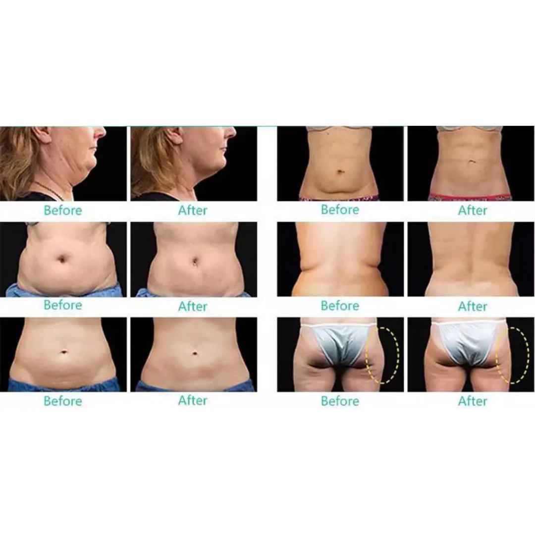 Fat Blaster 9 in 1 Lipo Laser Cavitation Machine - Image 3