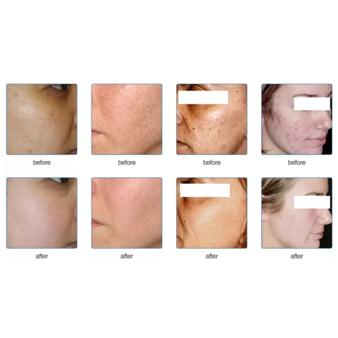DermaLaze™ Delicate PRO 3 in 1 E-Light Skin Rejuvenation System - Image 3