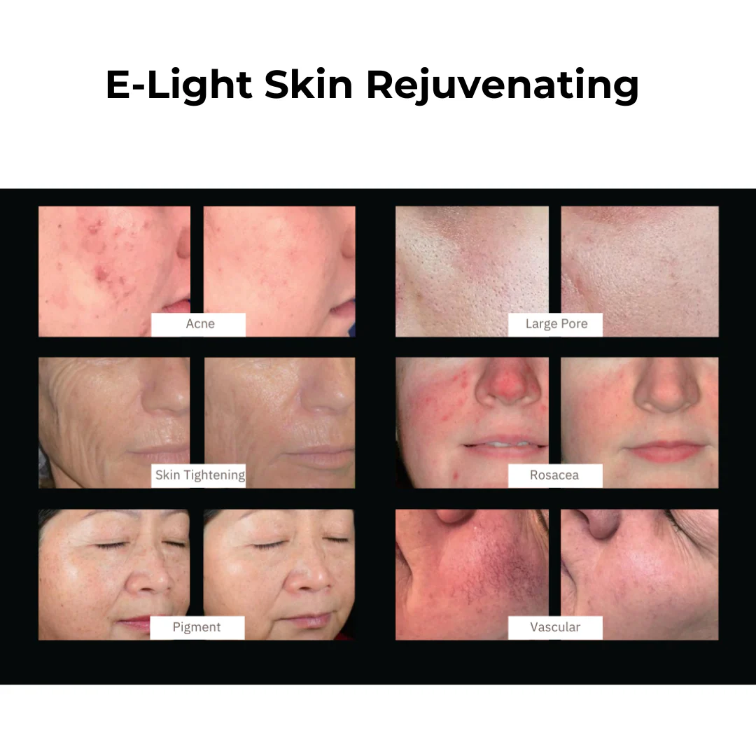 DermaLaze™ Delicate PRO 3 in 1 E-Light Skin Rejuvenation System - Image 9