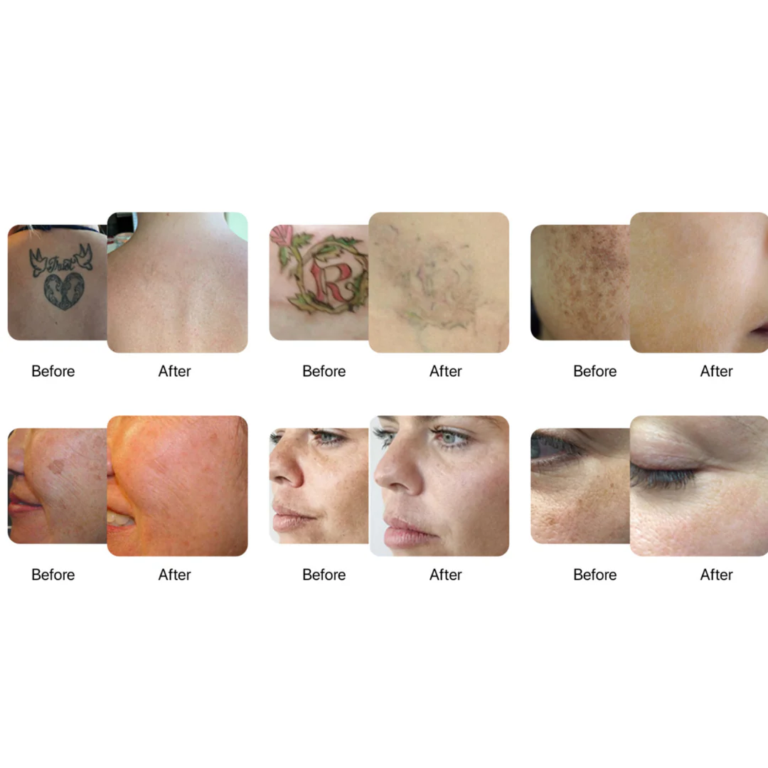 Dynamic 4 Wave Nano-Erase Tattoo Removal Laser Machine - Image 6