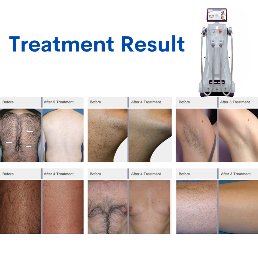 DiolaSheer™ Ice Hair Removal Laser Machine (4 Wavelengths) - Image 4