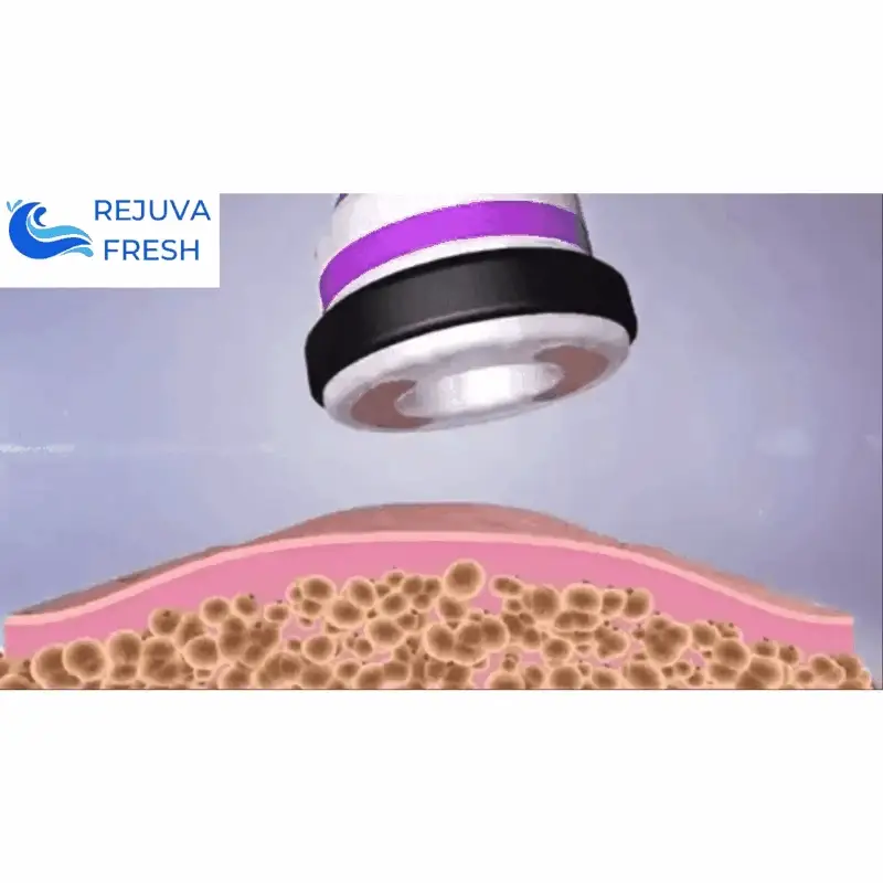 Adonis™ 6 in 1 Cavitation Machine for Fat Blasting - Image 12