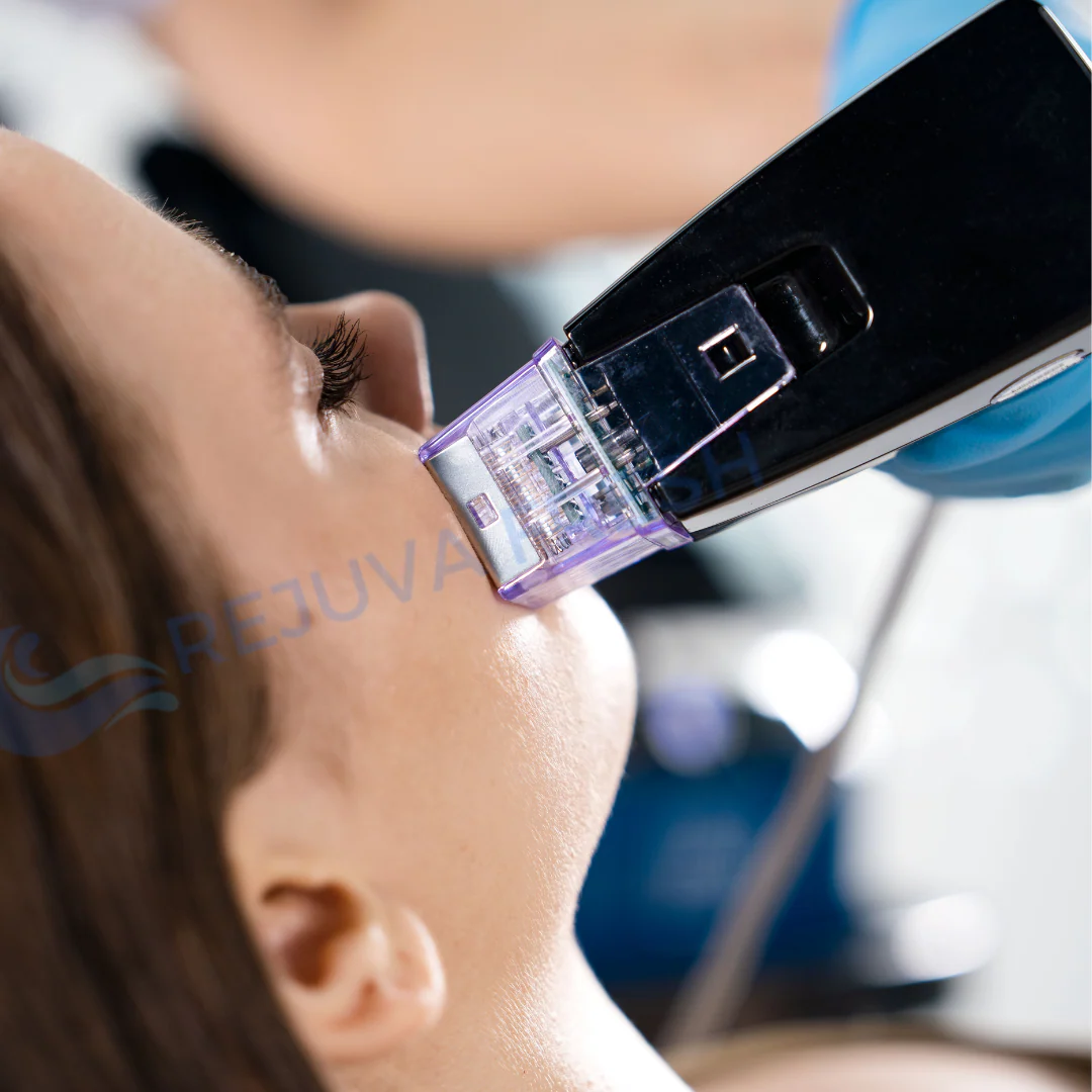 Metamorph8.5™ Golden Youth RF Microneedling Machine - Image 11