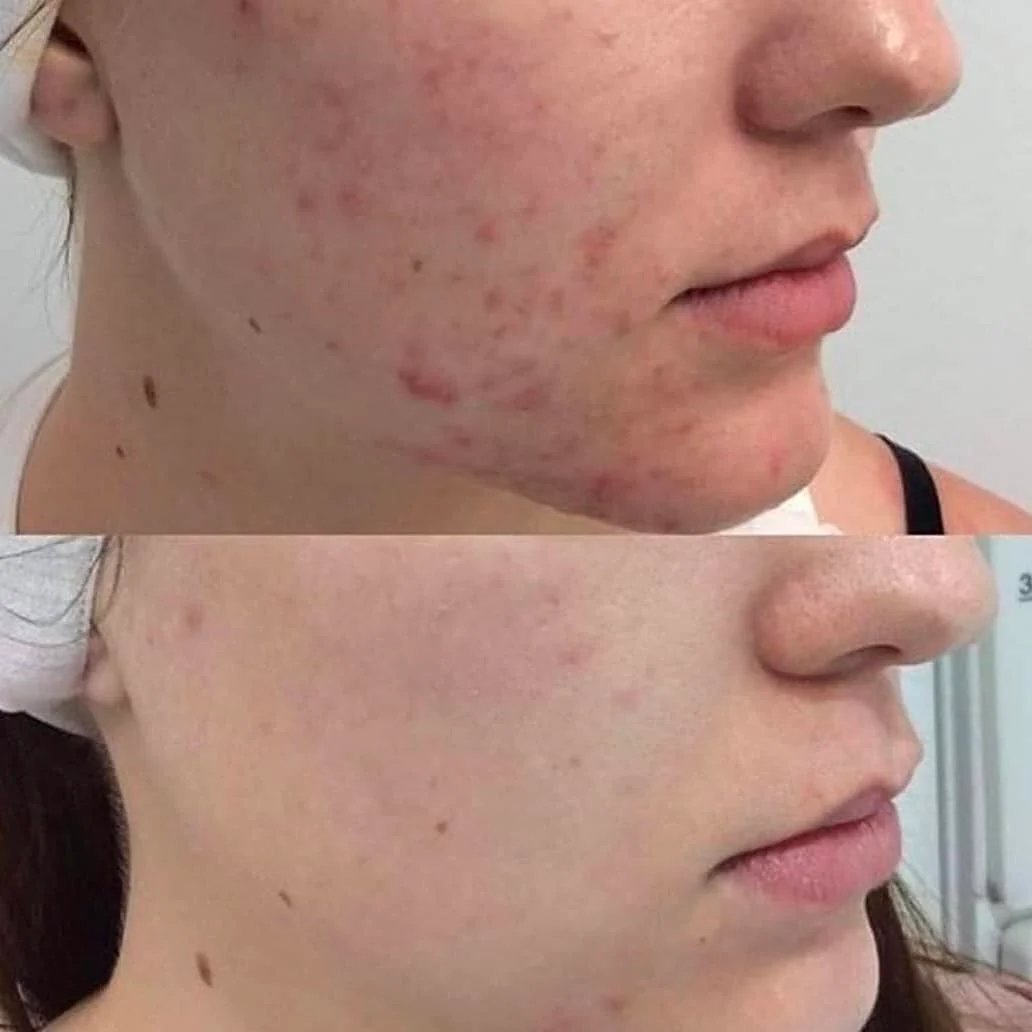 Metamorph8.5™ Golden Youth RF Microneedling Machine - Image 20