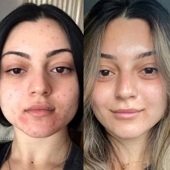 Metamorph8.5™ Golden Youth RF Microneedling Machine - Image 21