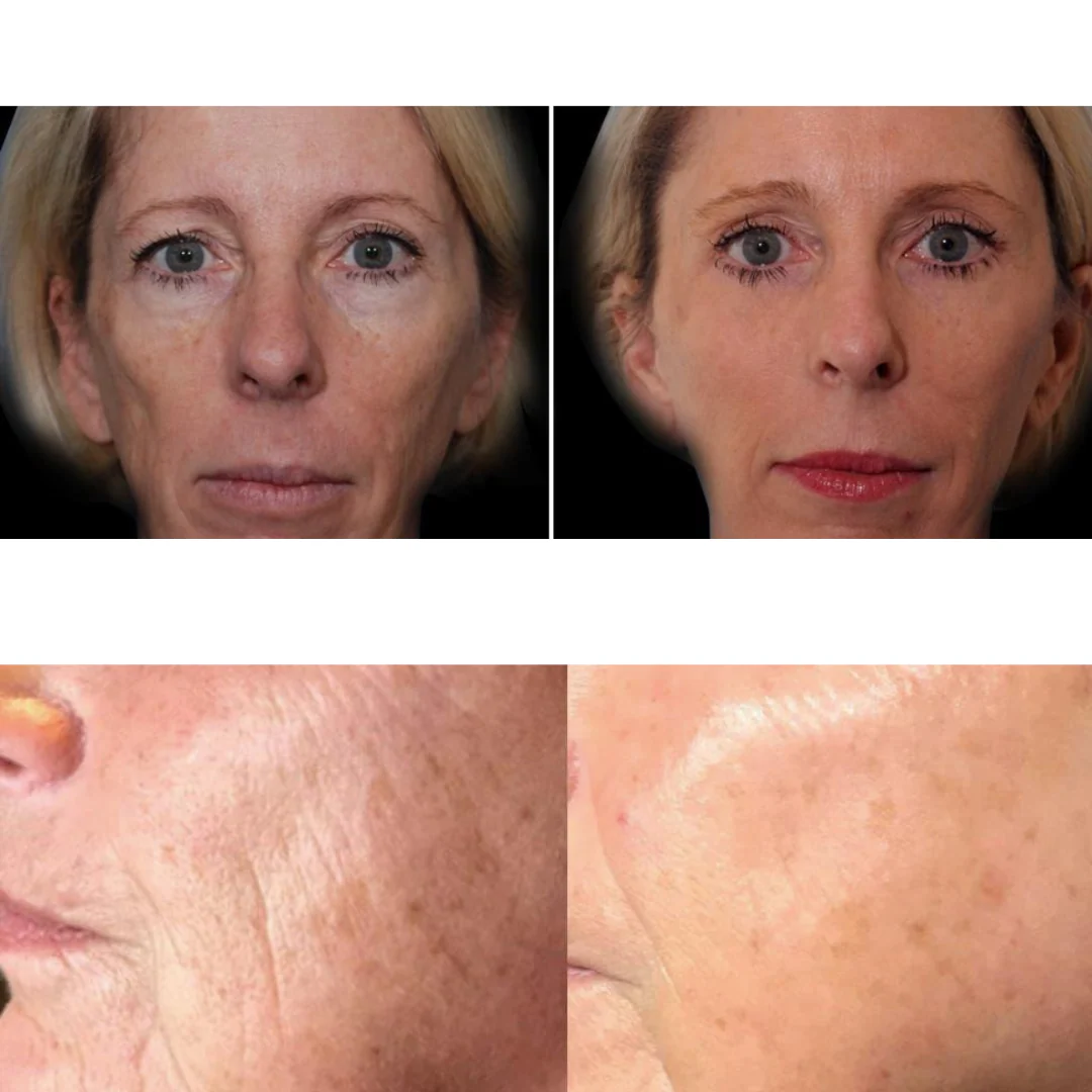 Metamorph8.5™ Golden Youth RF Microneedling Machine - Image 23