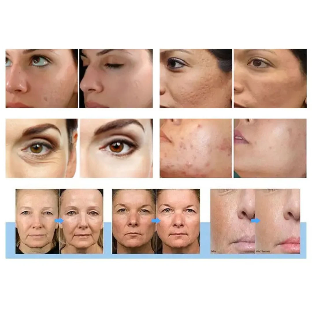 Metamorph8.5™ Golden Youth RF Microneedling Machine - Portable - Image 12