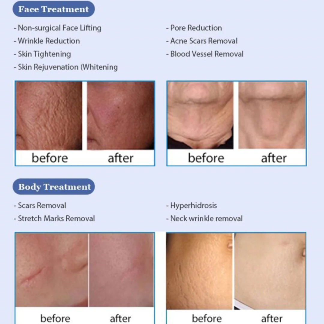 GlowSkin Neo Golden RF Microneedling & Fractional RF - Image 7