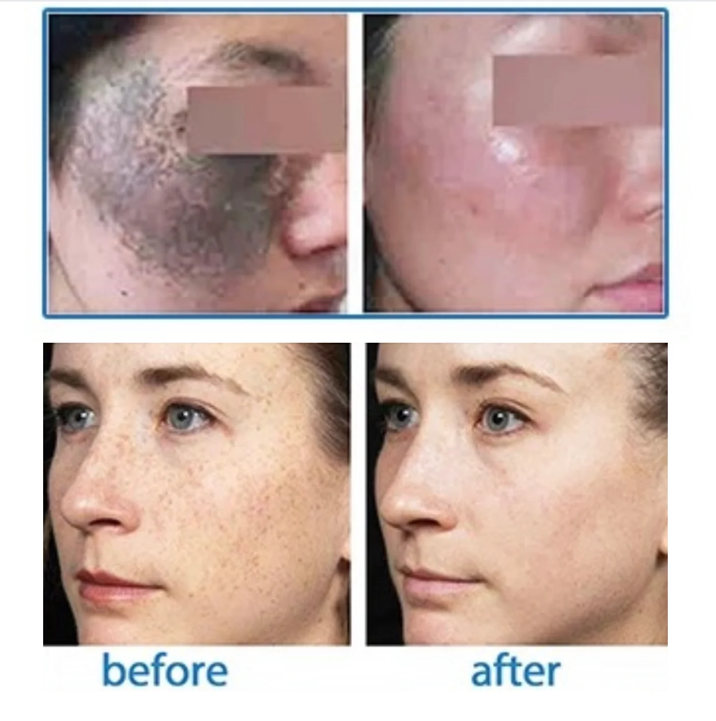 Luna Ink Pro Nanosecond Laser Tattoo Removal Machine - Image 11