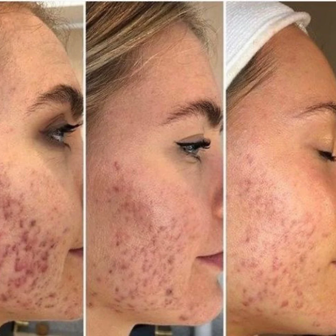 Pro-Secret™ Icy Gold RF Microneedling Machine - Image 20