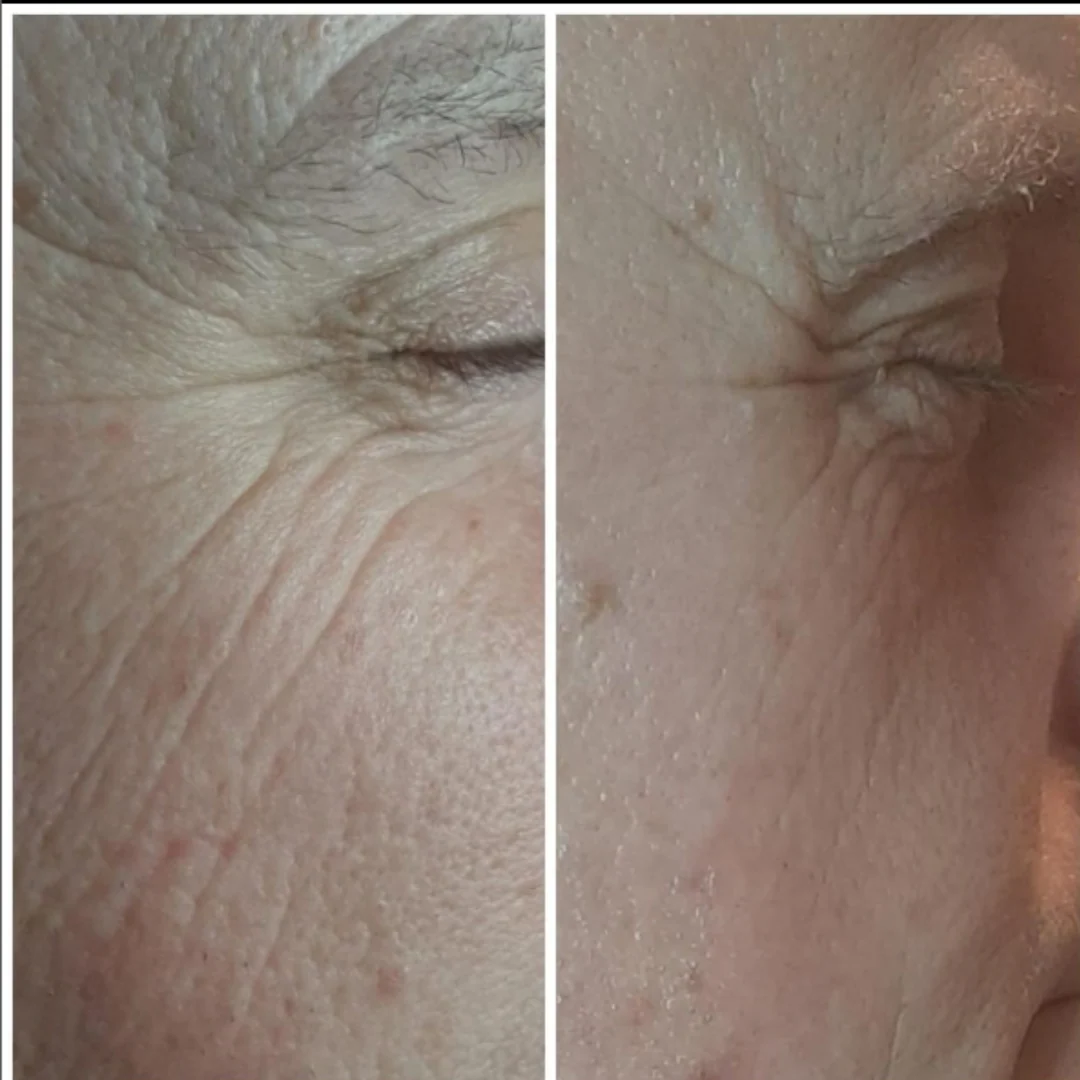 Pro-Secret™ Icy Gold RF Microneedling Machine - Image 21