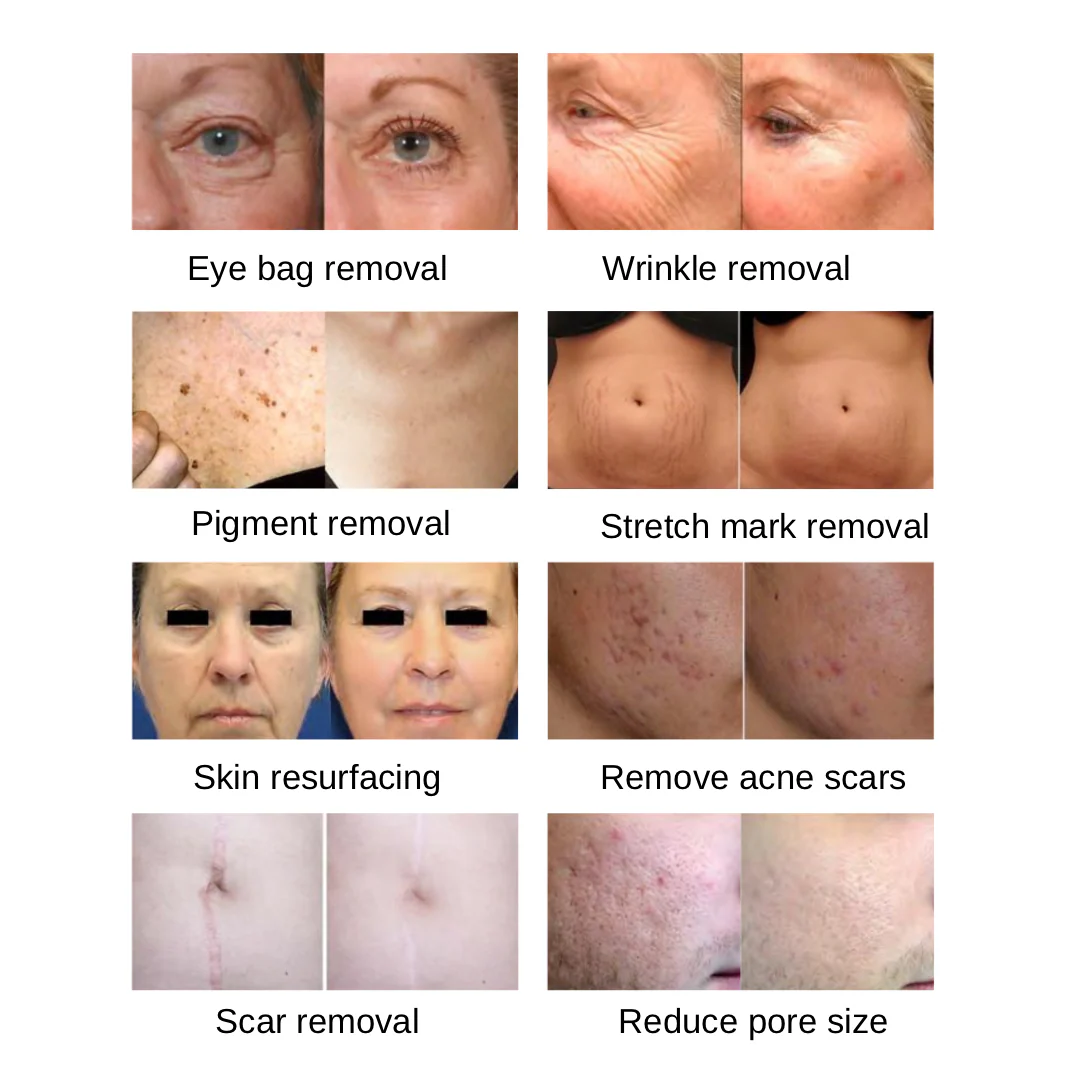 ReDerma™ Fractional CO2 Laser - Image 5